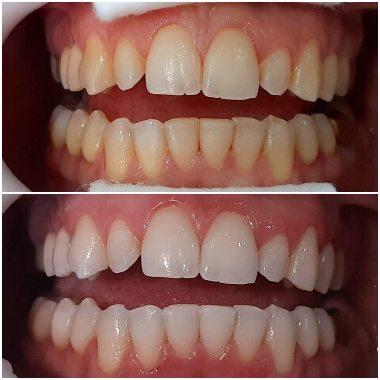 Seus dentes amarelos te incomodam?