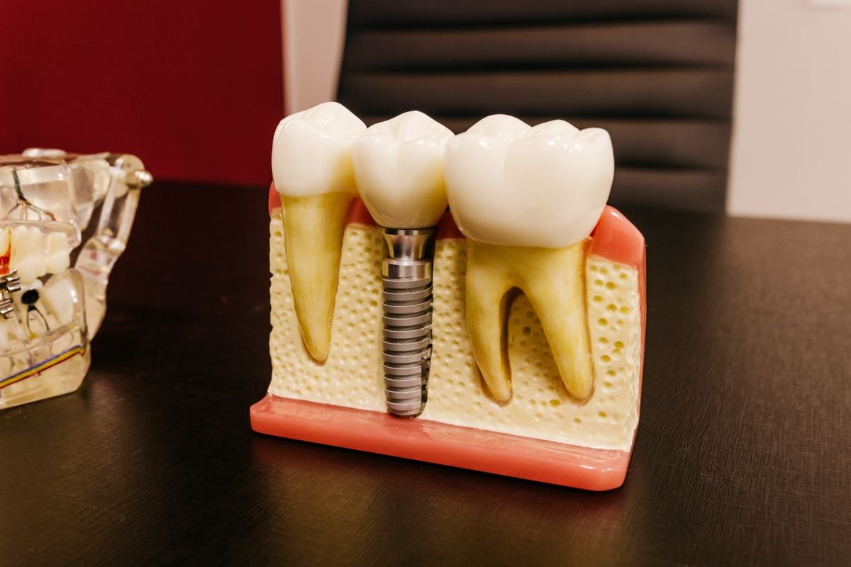 Modelo anatômico mostrando um implante dentário na arcada